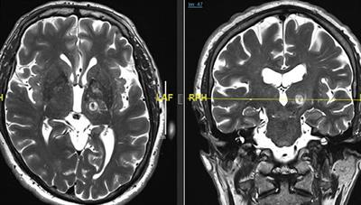 Magnetic Resonance Image Guided Focused Ultrasound Thalamotomy. A Single Center Experience With 160 Procedures